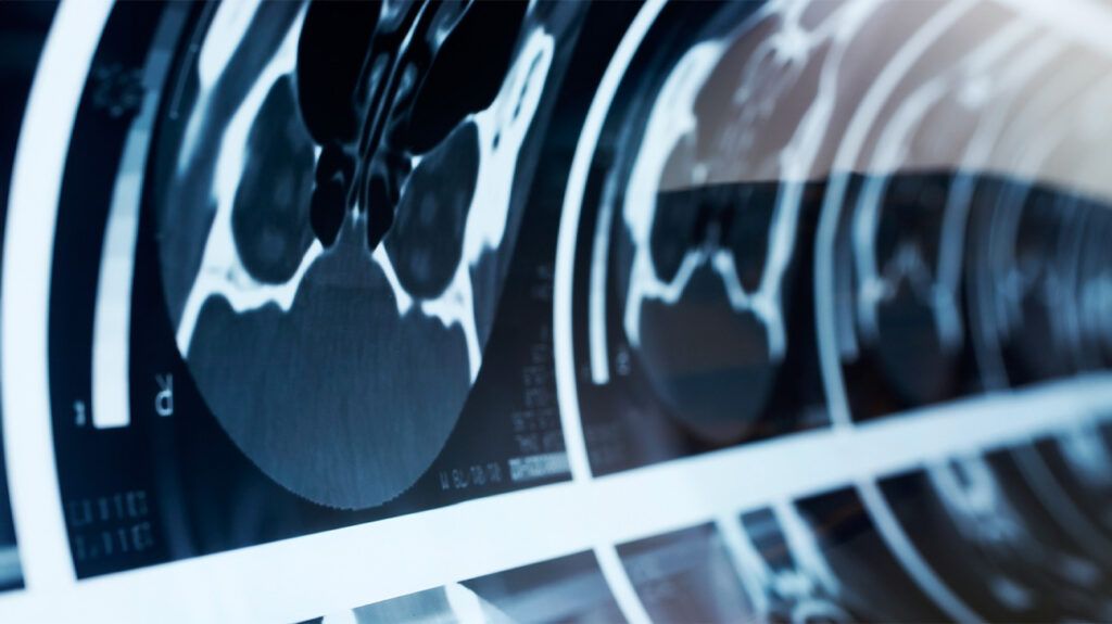 Close-up of brain CT scans to look for signs of ICANS.