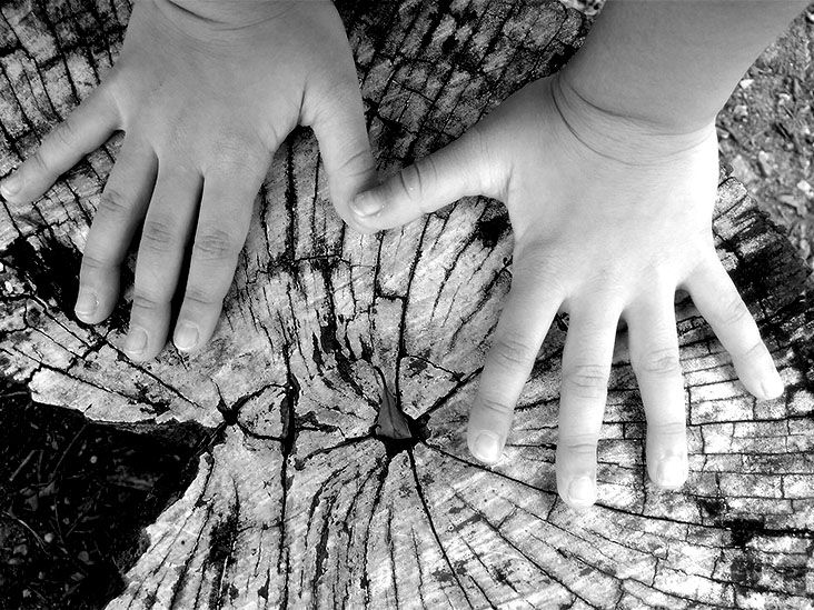 Complications of neurofibromatosis type 1 plexiform neurofibromas