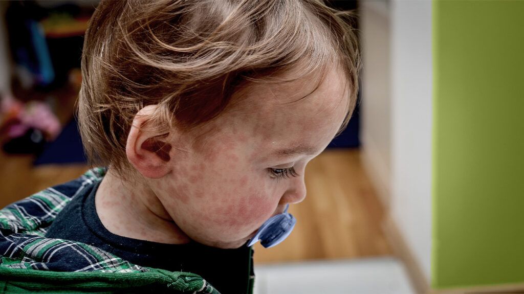 A young child with a rash on their face 1