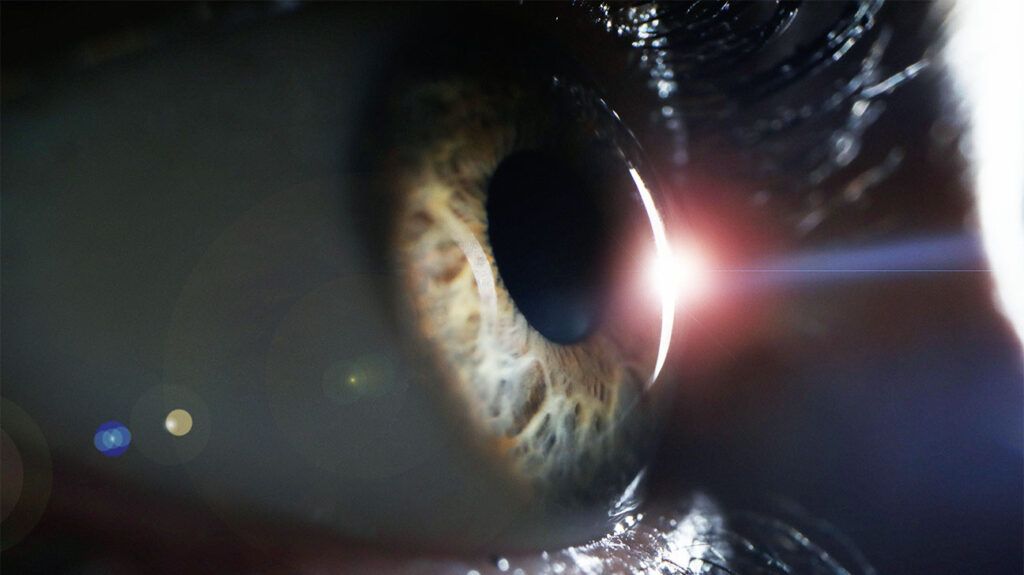 A close-up image of an eye from the side after someone has had laser surgery for a retinal tear.-2