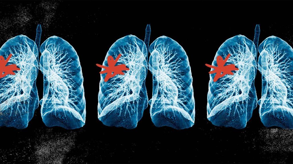 Four lung scans are highlighted in blue