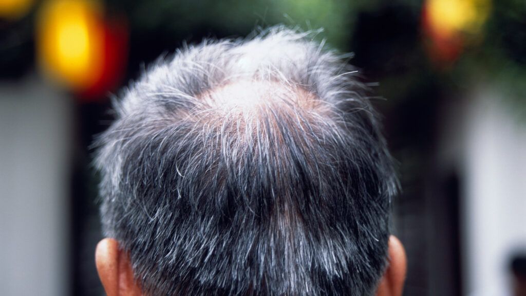 back of man's head showing male pattern baldness