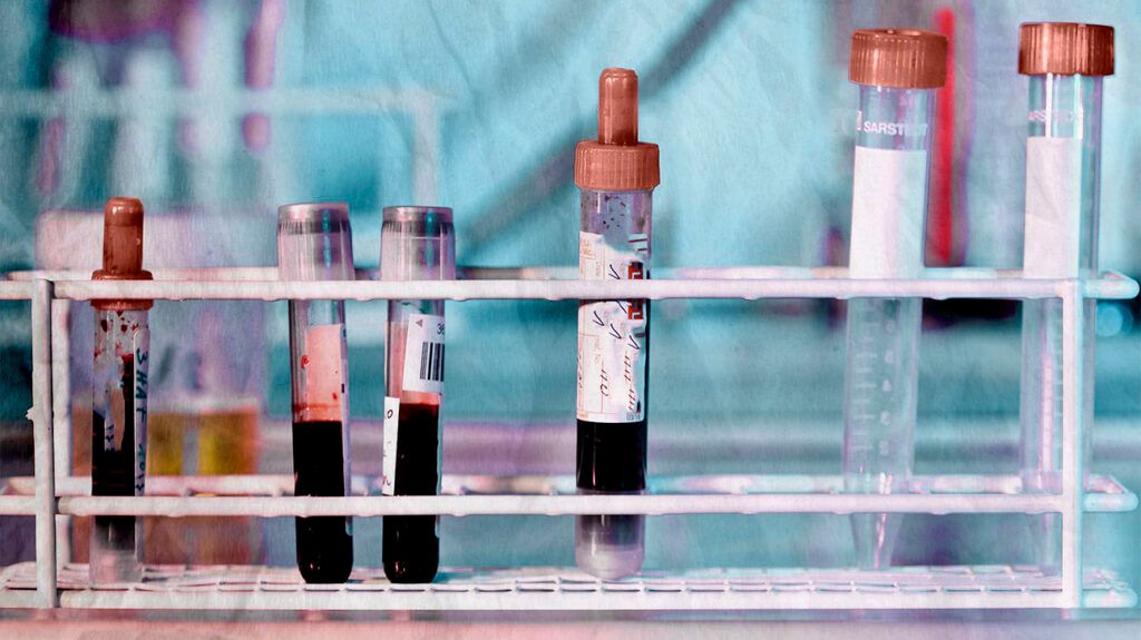 Samples of blood to help diagnose myasthenia gravis -2