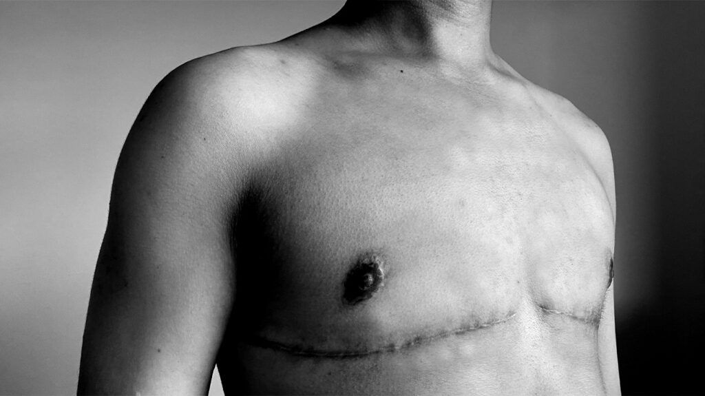 A person with a scar from undergoing top surgery -1