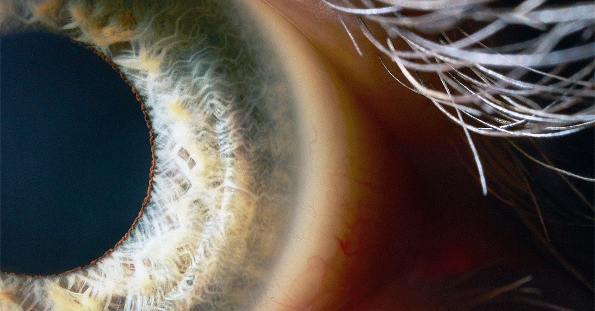 Central Retinal Vein Occlusion: Symptoms, Causes, And More