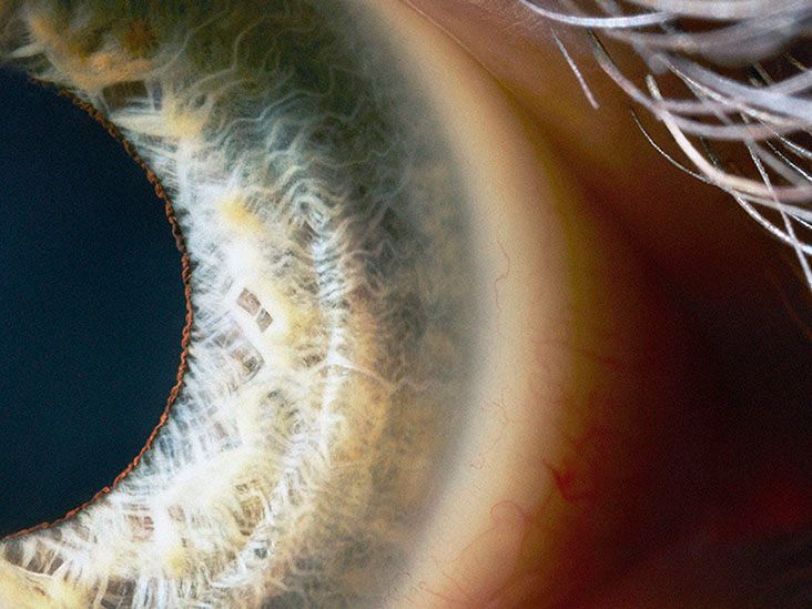 Central retinal vein occlusion: Symptoms, causes, and more