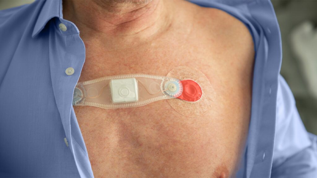 A person's chest with ECG monitor sensors, indicated in the Jones criteria for rheumatic heart disease. -1 