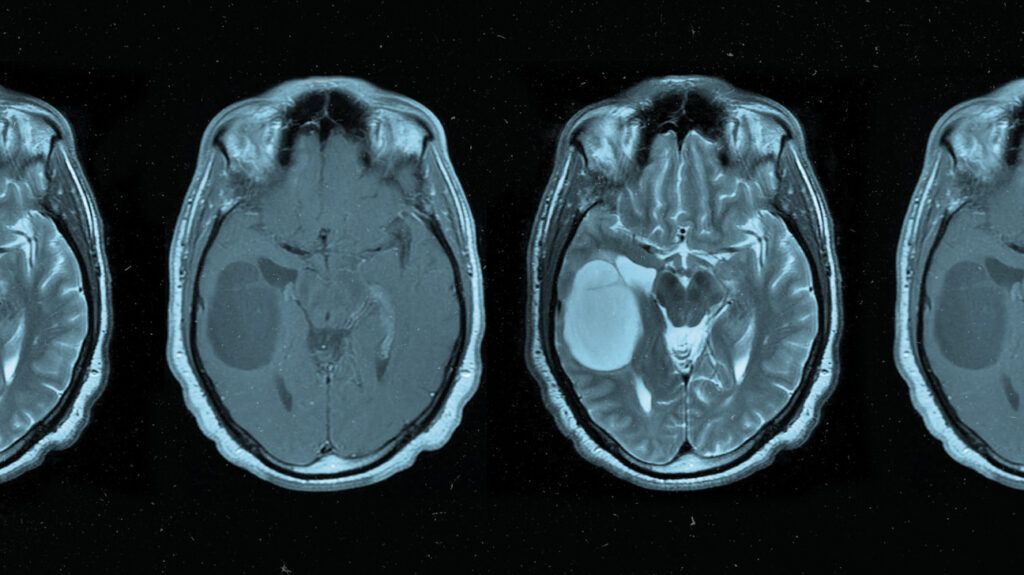 A series of brain scans showing oligodendroglioma