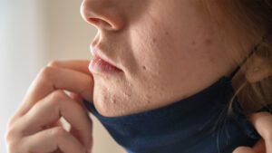 Acne mechanica: Symptoms, causes, treatments, and more