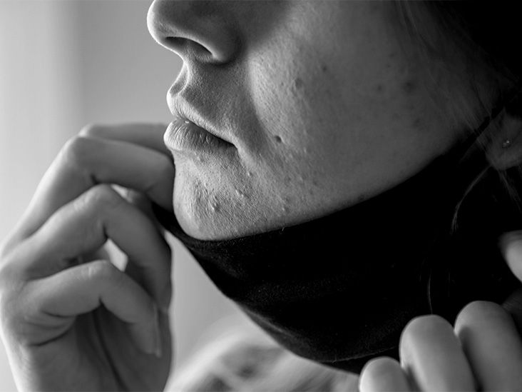 Acne mechanica: Symptoms, causes, treatments, and more