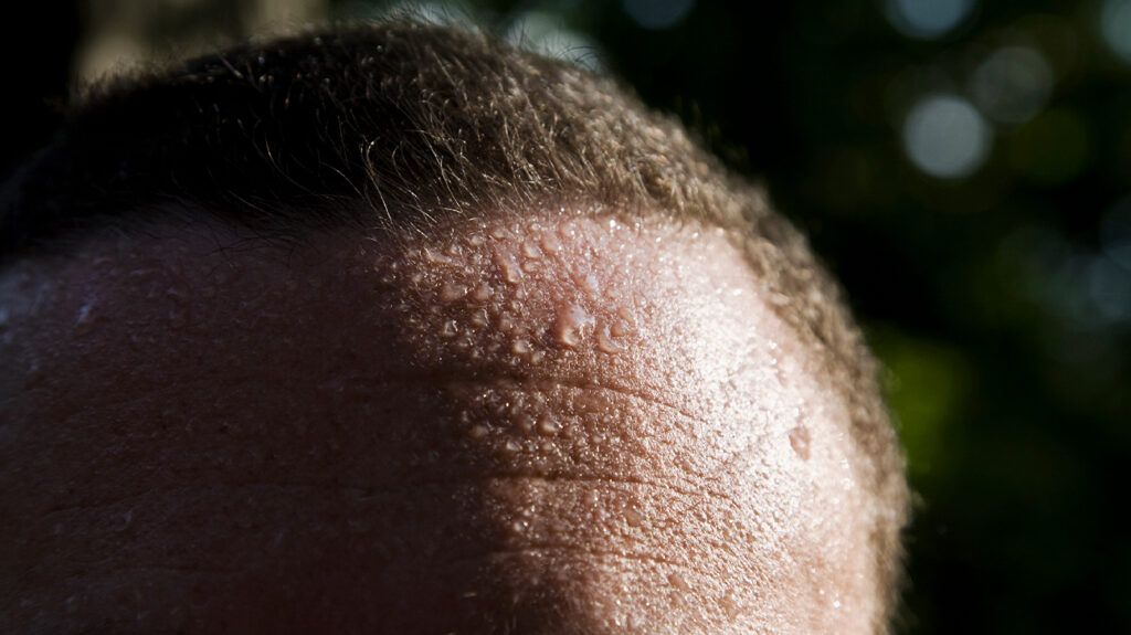 Sweat on the forehead of a person with hyperhidrosis.-2