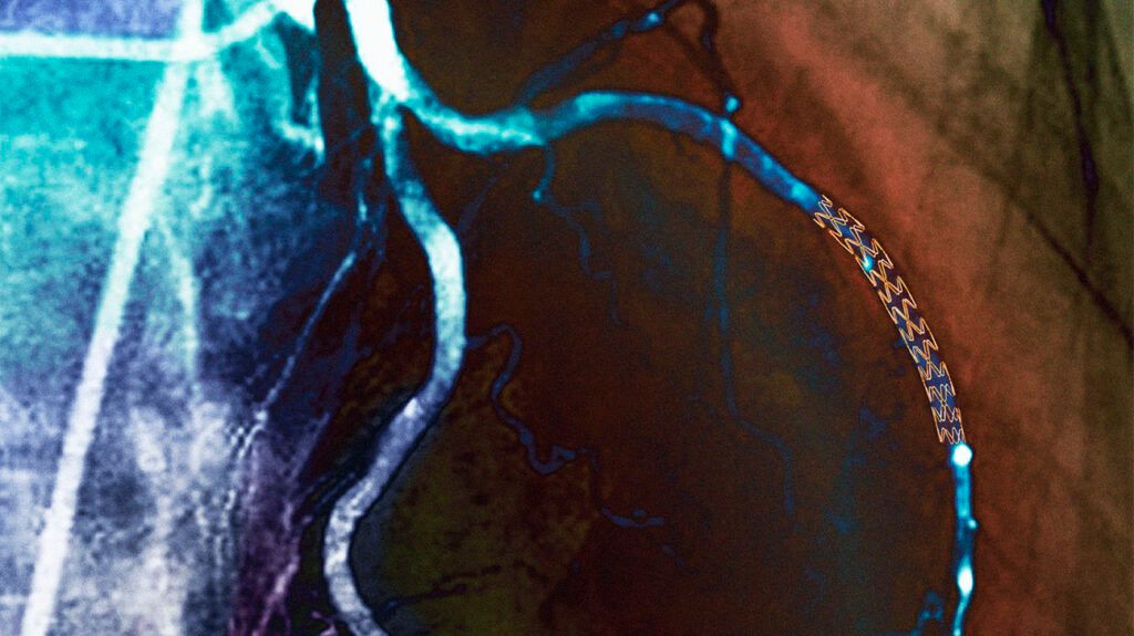 Coronary stent on an X-ray-1