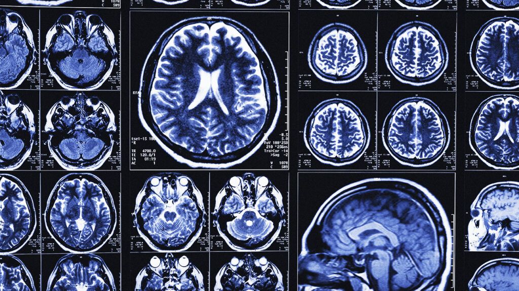 MRI bran scans and images of magnetic resonance tomography