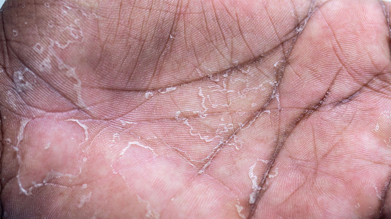 Scabies Bumpy Rash Scabies Bumps On Fingers