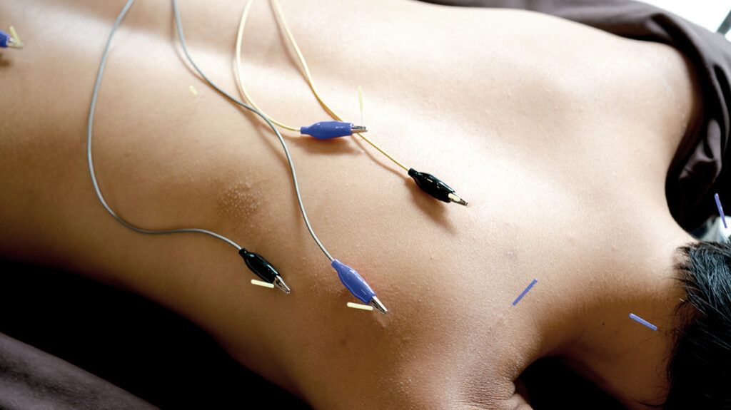 Electroacupuncture needles on a bare back