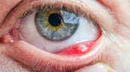 What Causes A Stye STYE Ishwar Eye Centre