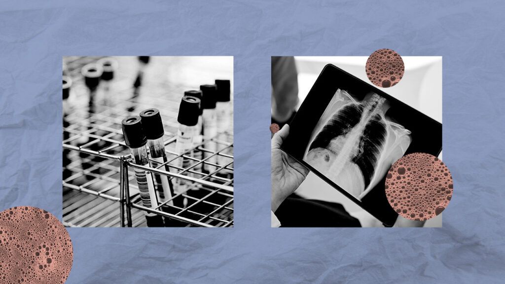 Collage showing blood collection tubes and a chest X-ray.