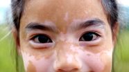 Newborn Baby White Spots On Face Newborn Baby White Spots On Face