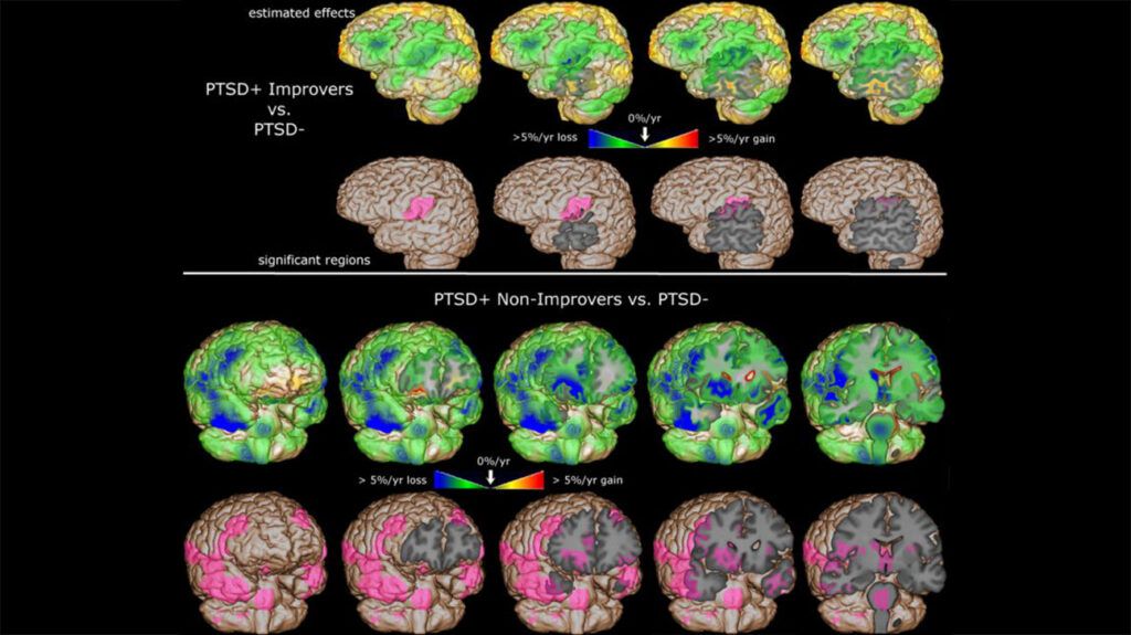 How PTSD affects the brain