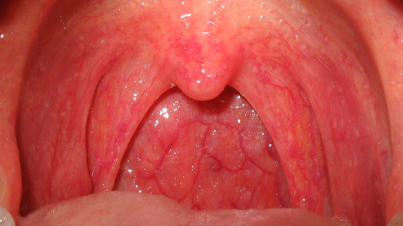 Red spots on roof of mouth Causes and other symptoms