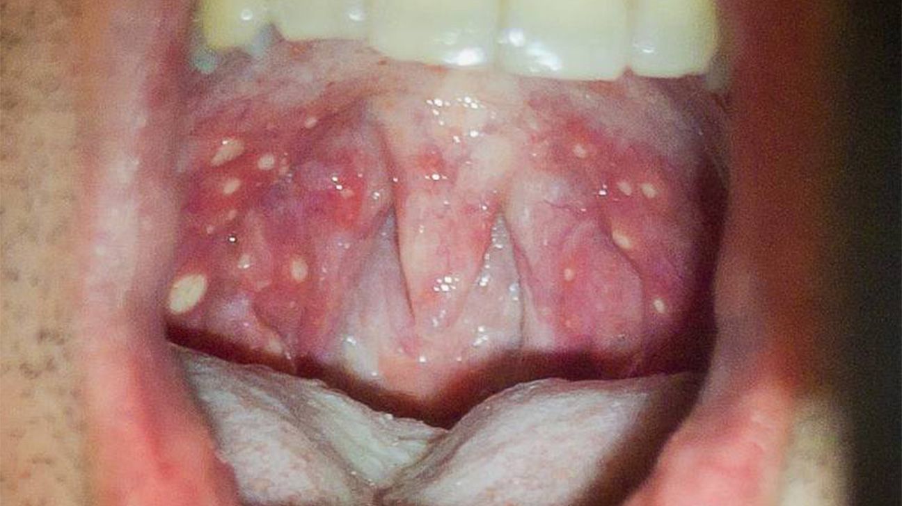 Red spots on roof of mouth: Causes and other symptoms