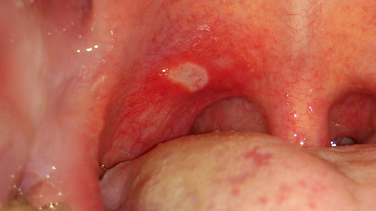 Red spots on roof of mouth: Causes and other symptoms