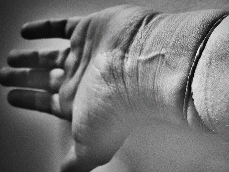 What is aversion therapy?