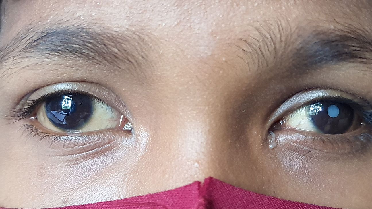 A cataract that develops in children is called a congenital cataract