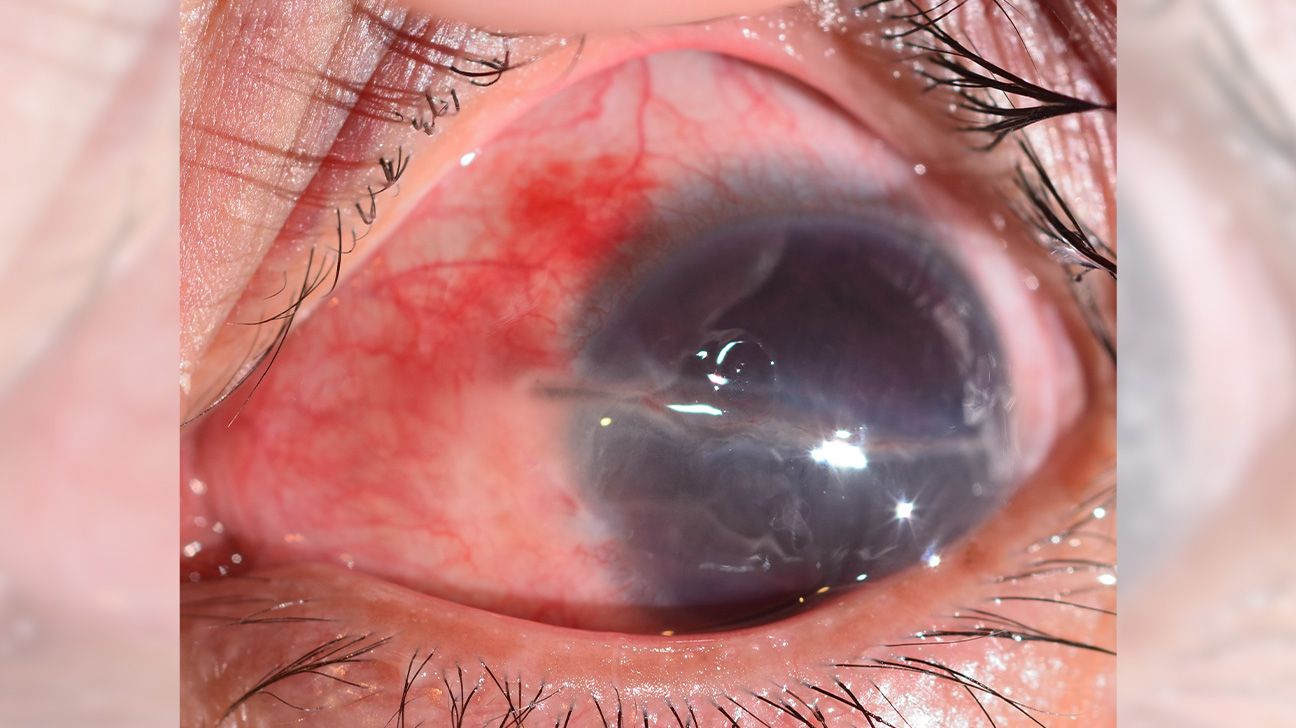 A traumatic cataract develops due to injury or trauma to the eye.