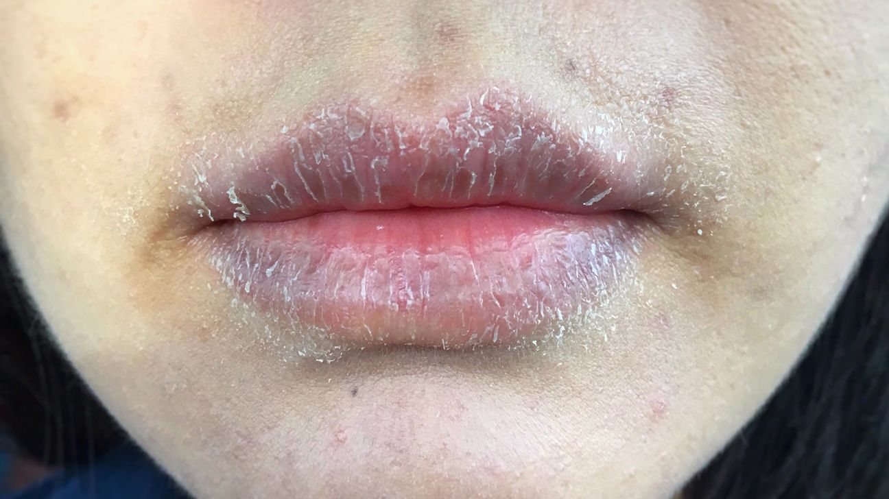 Allergic reaction on lips: Causes, symptoms, treatment, and more