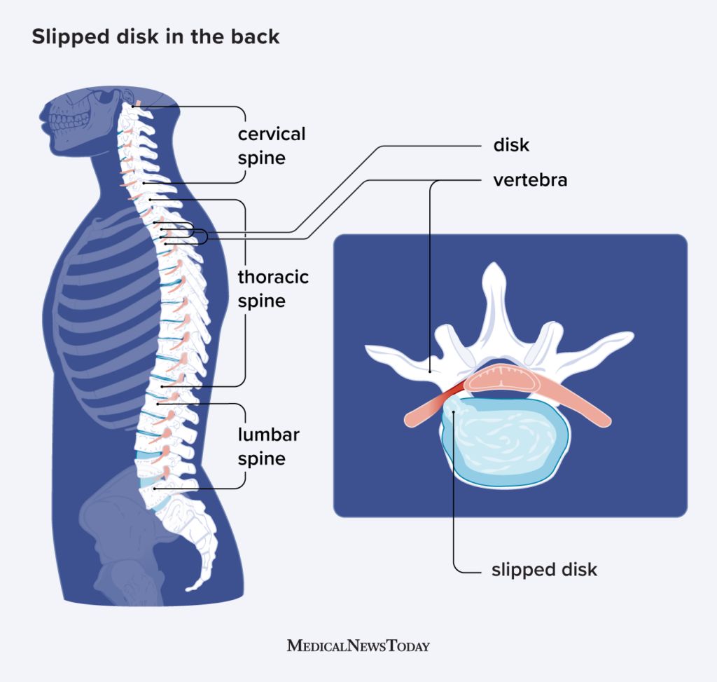 Illustration of the spine and a slipped disk