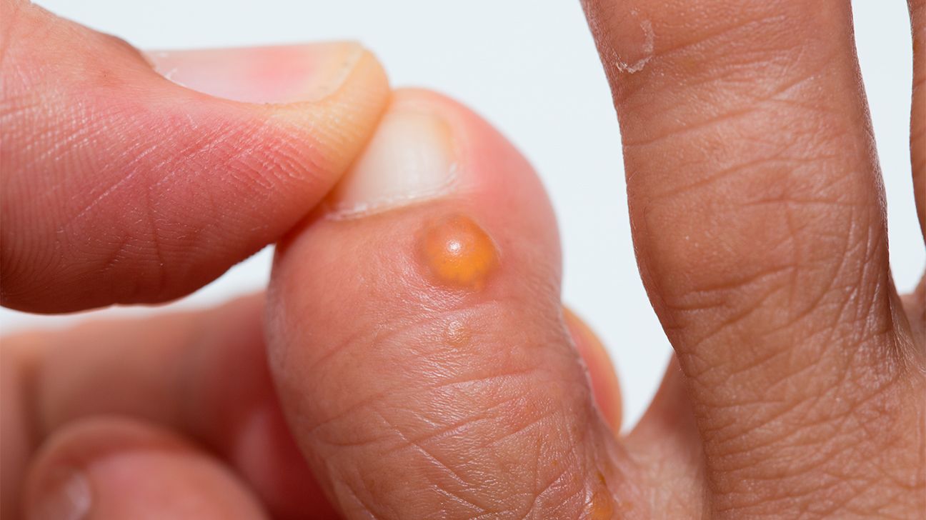 Dyshidrotic eczema What to know about summer finger bumps