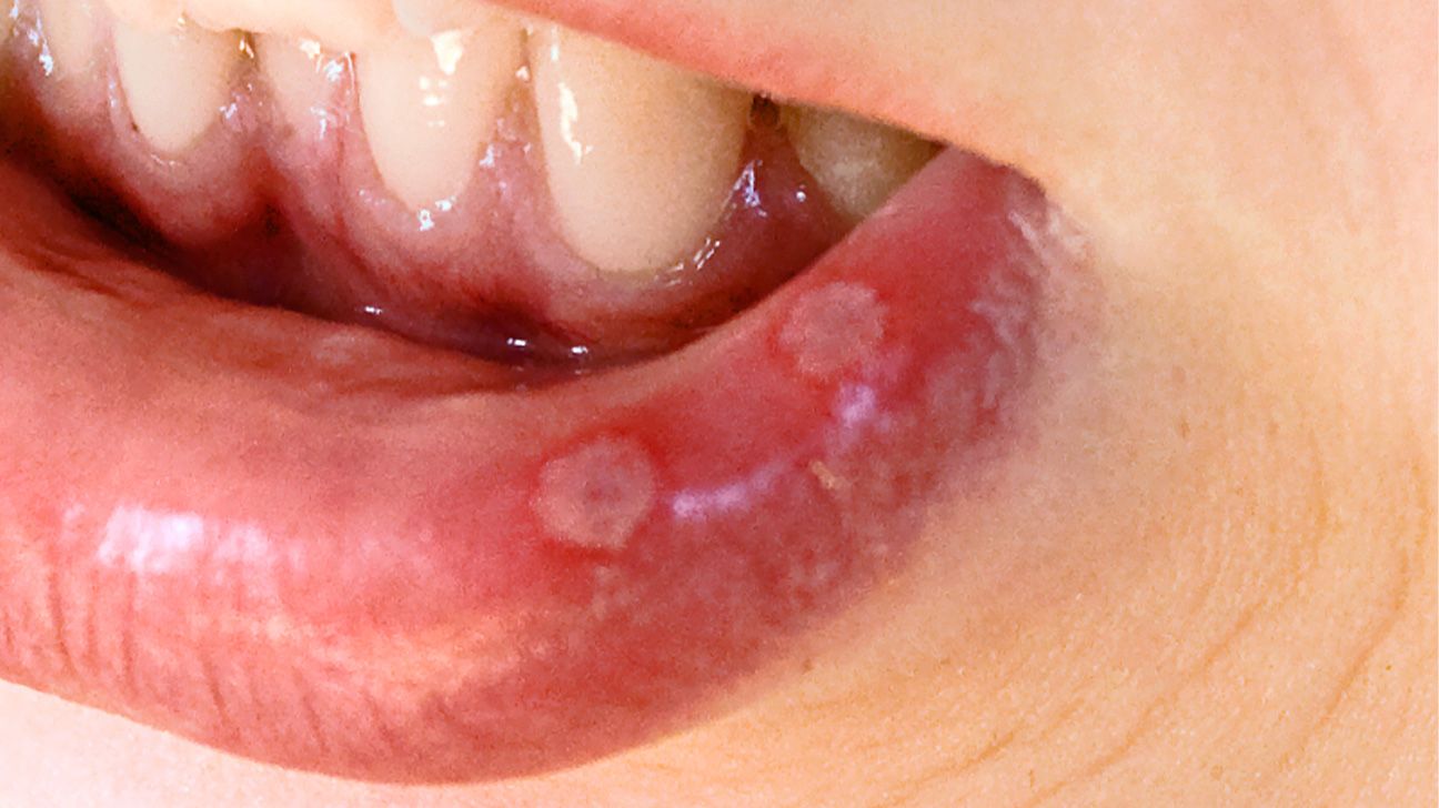 Mouth ulcers Types, causes, symptoms, and treatment