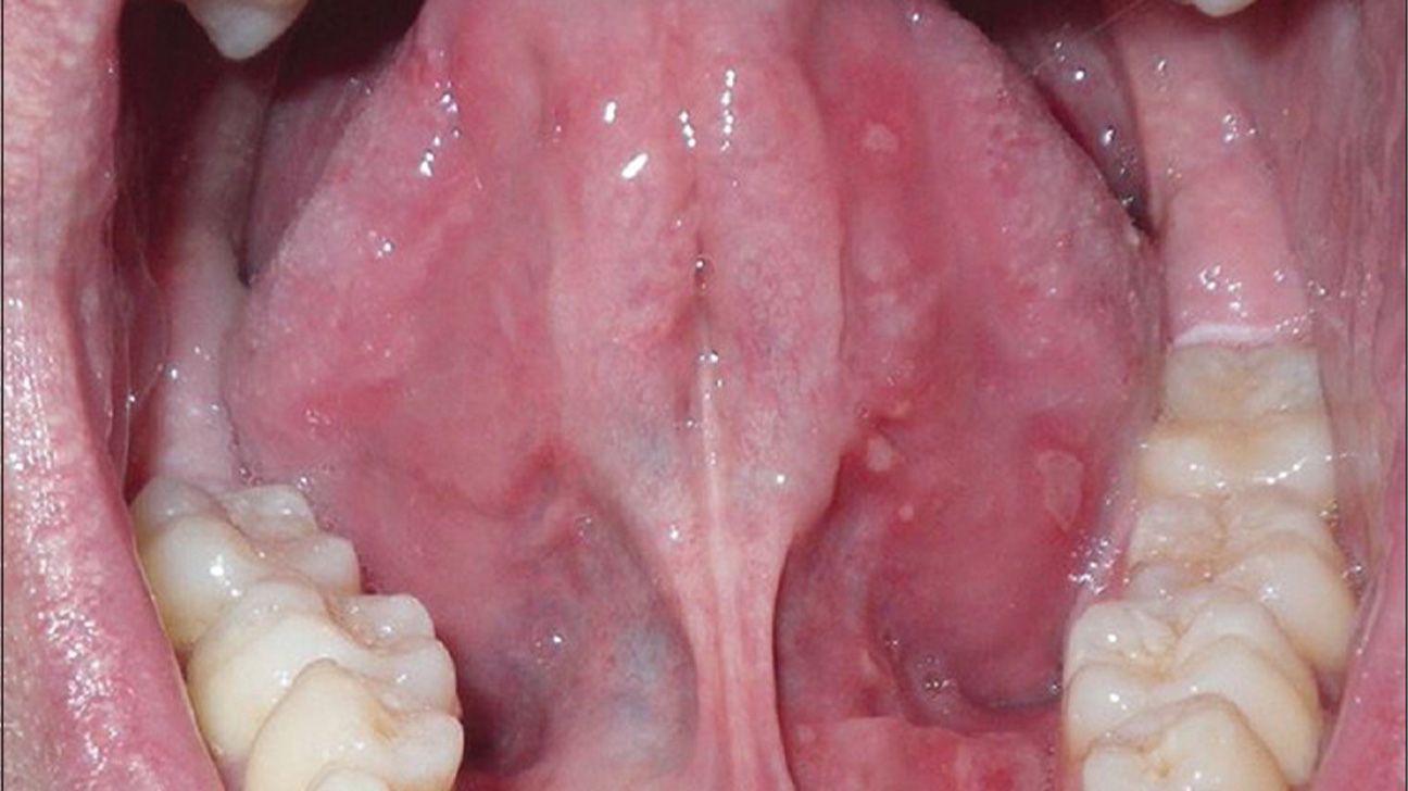 Mouth ulcers Types, causes, symptoms, and treatment