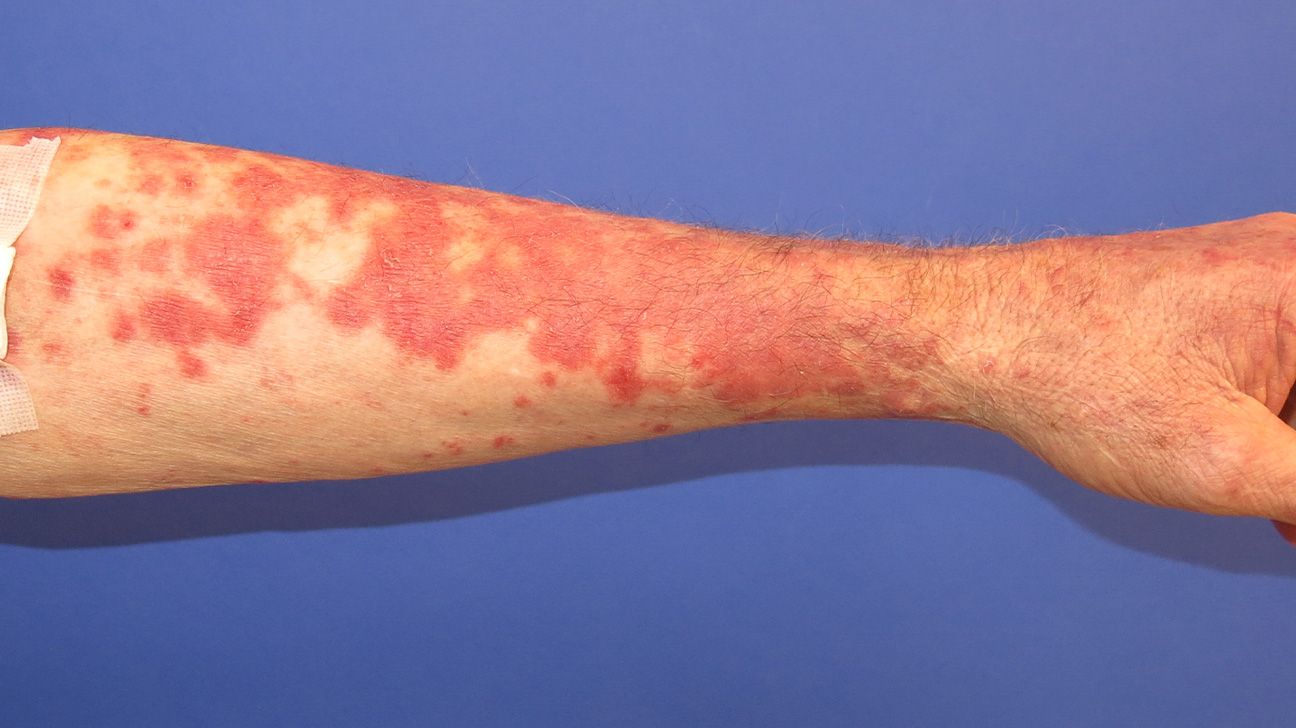 Paraneoplastic pemphigus: Symptoms, causes, and more