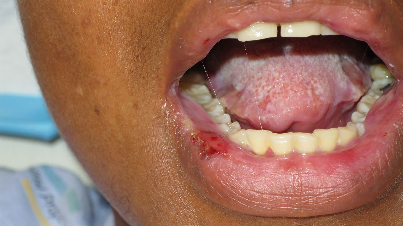 Mouth ulcers Types, causes, symptoms, and treatment