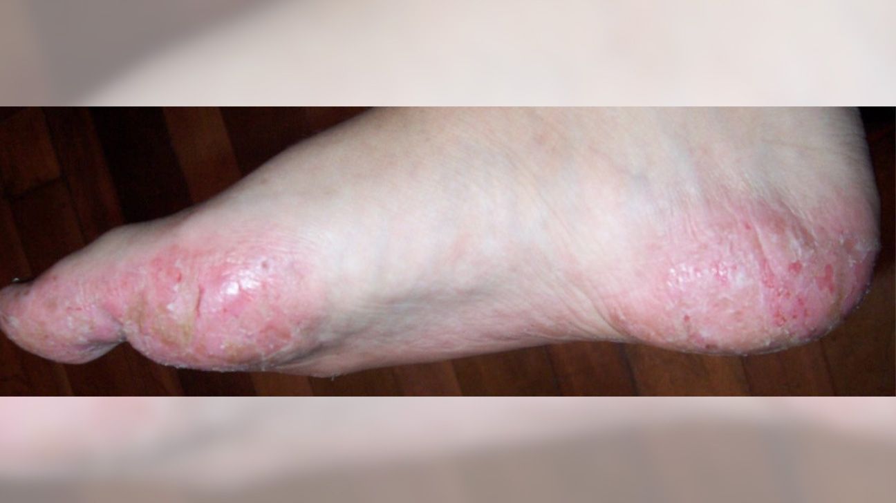 what-causes-red-spots-on-bottom-of-feet-infoupdate