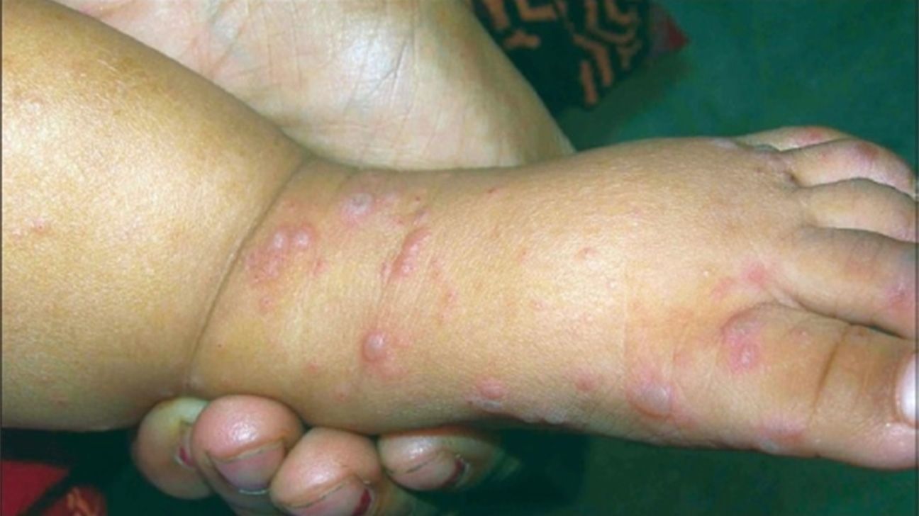 Foot Path Rash What Is A Skin Rash And How To Treat It Marietta Foot Do I Have