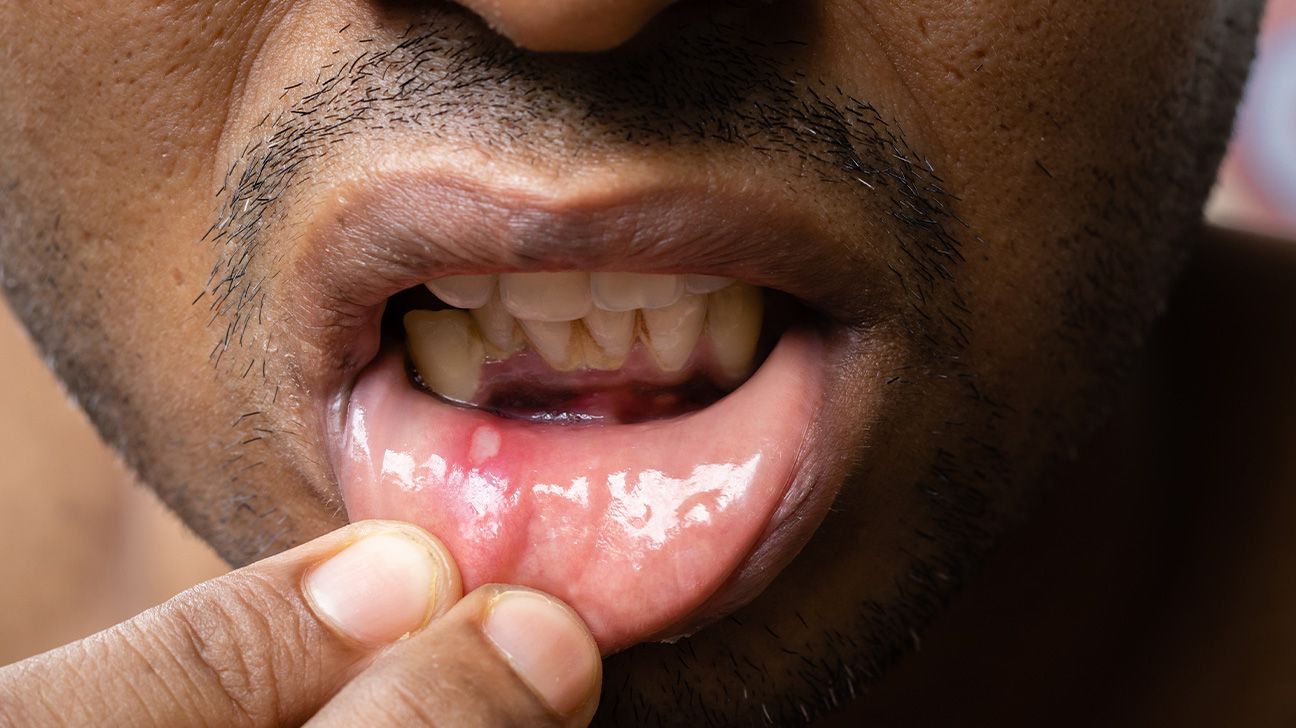 Canker sore vs. cold sore: How to tell the difference and more, image size:1296x728