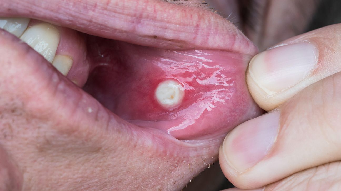 Canker sore vs. cold sore: How to tell the difference and more, image size:1296x728
