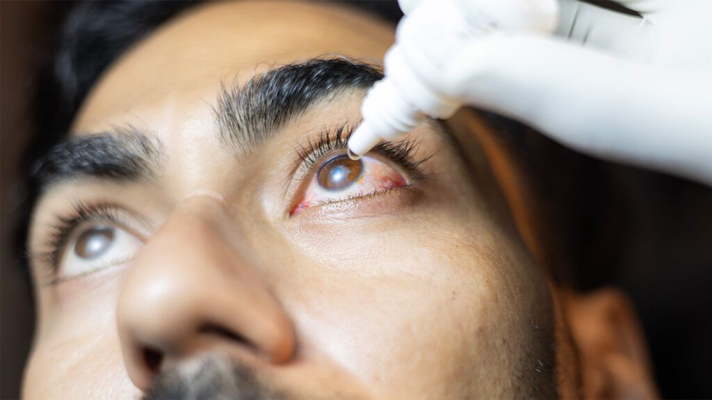 A person applying eye drops to treat pneumococcal conjunctivitis.