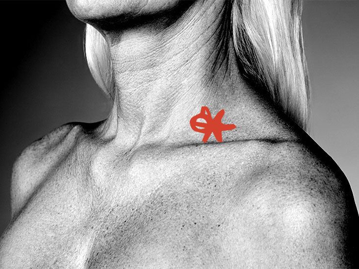 Swollen Supraclavicular Lymph Nodes Swollen Supraclavicular Lymph Nodes