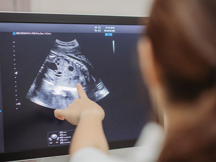 Complex ovarian cyst: Symptoms, risks, pictures, surgery