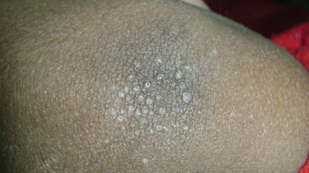 Crusty Skin On Elbow