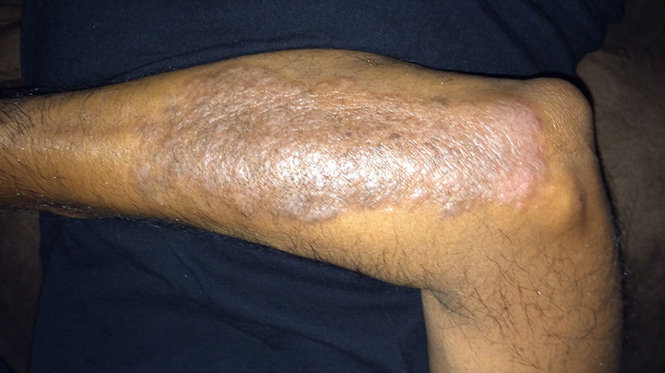Crusty Skin On Elbow