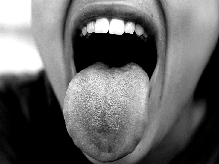 Une bouche ouverte montrant un aphte sur le côté de la langue.