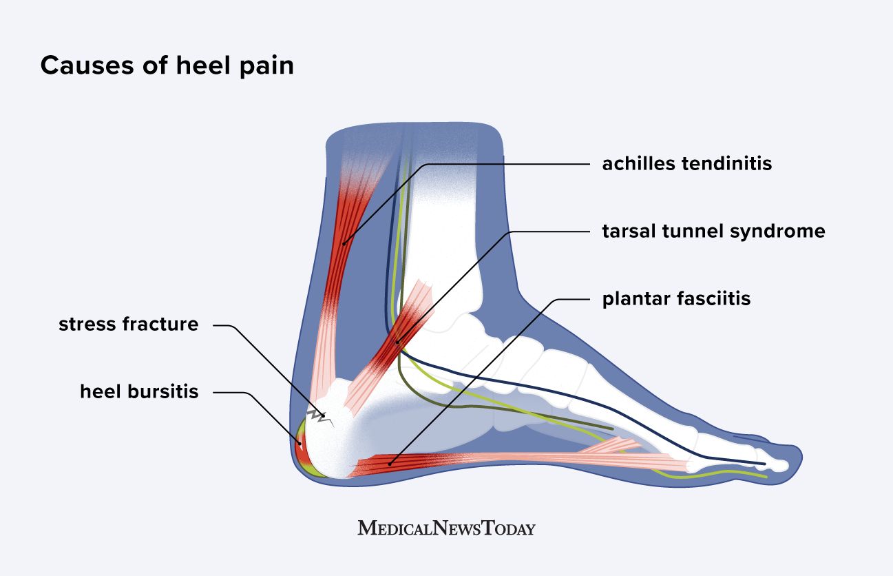 Heel pain: Causes, prevention, and treatments