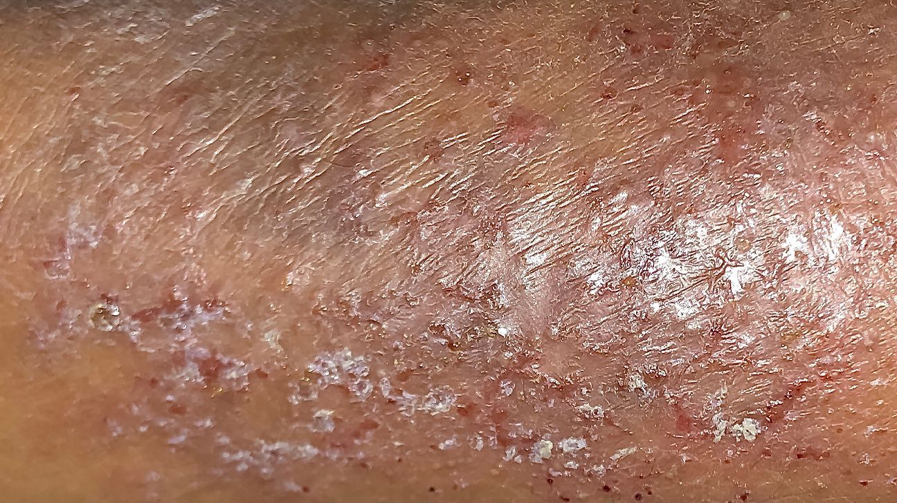 Red spots on penis: 10 causes and treatments, image size:1296x728