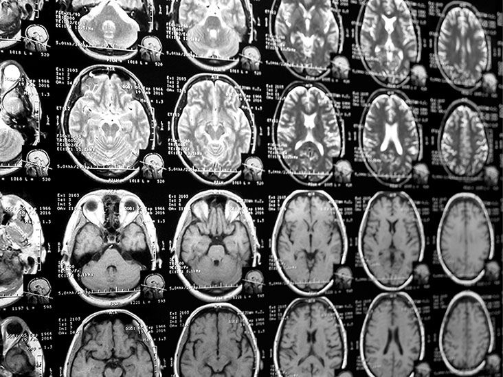 Treatment guide: VMAT2 inhibitors for Huntington’s disease