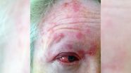 Early Shingles Rash On Face